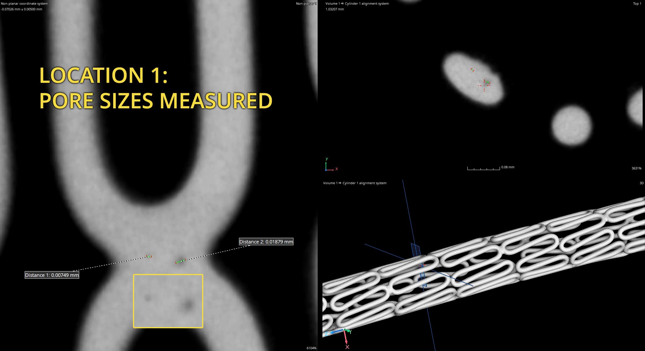 Stent CT Scan Porosity Location 1b