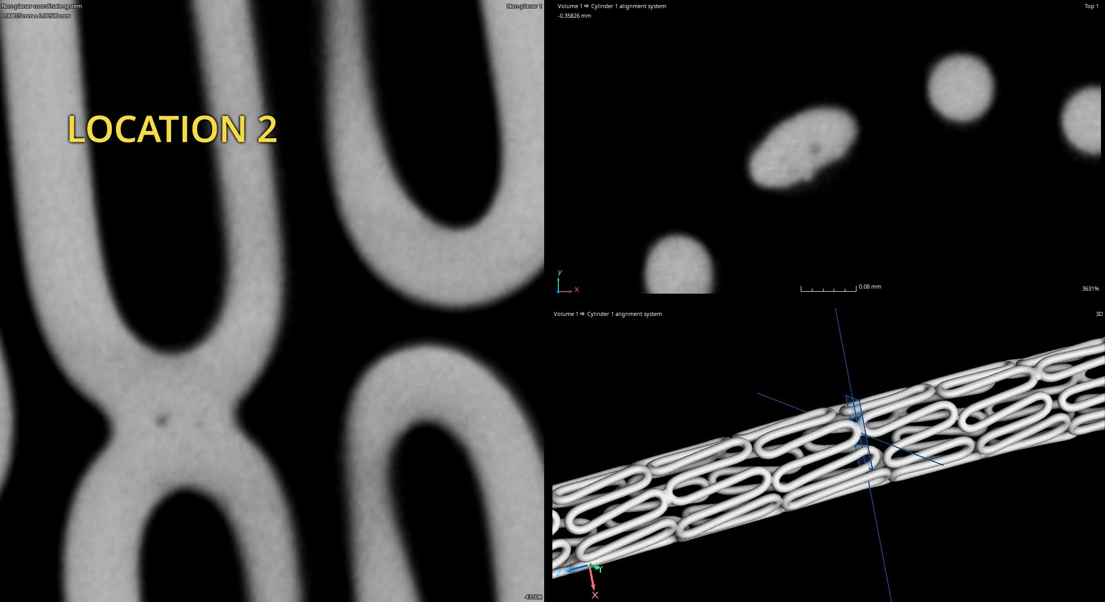 Stent CT Scan Porosity Location 2b