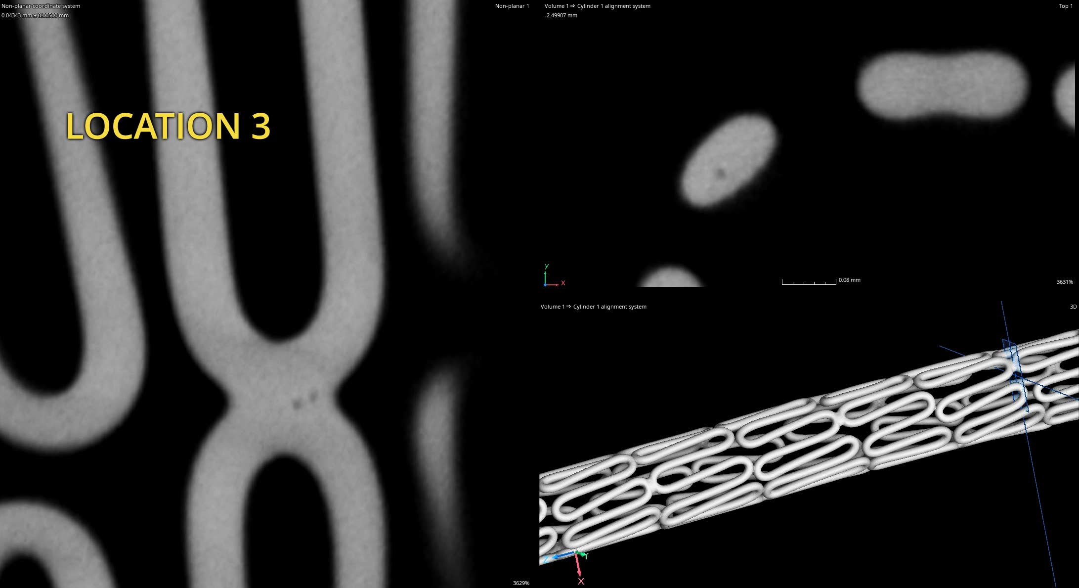 Stent CT Scan Porosity Location 3b